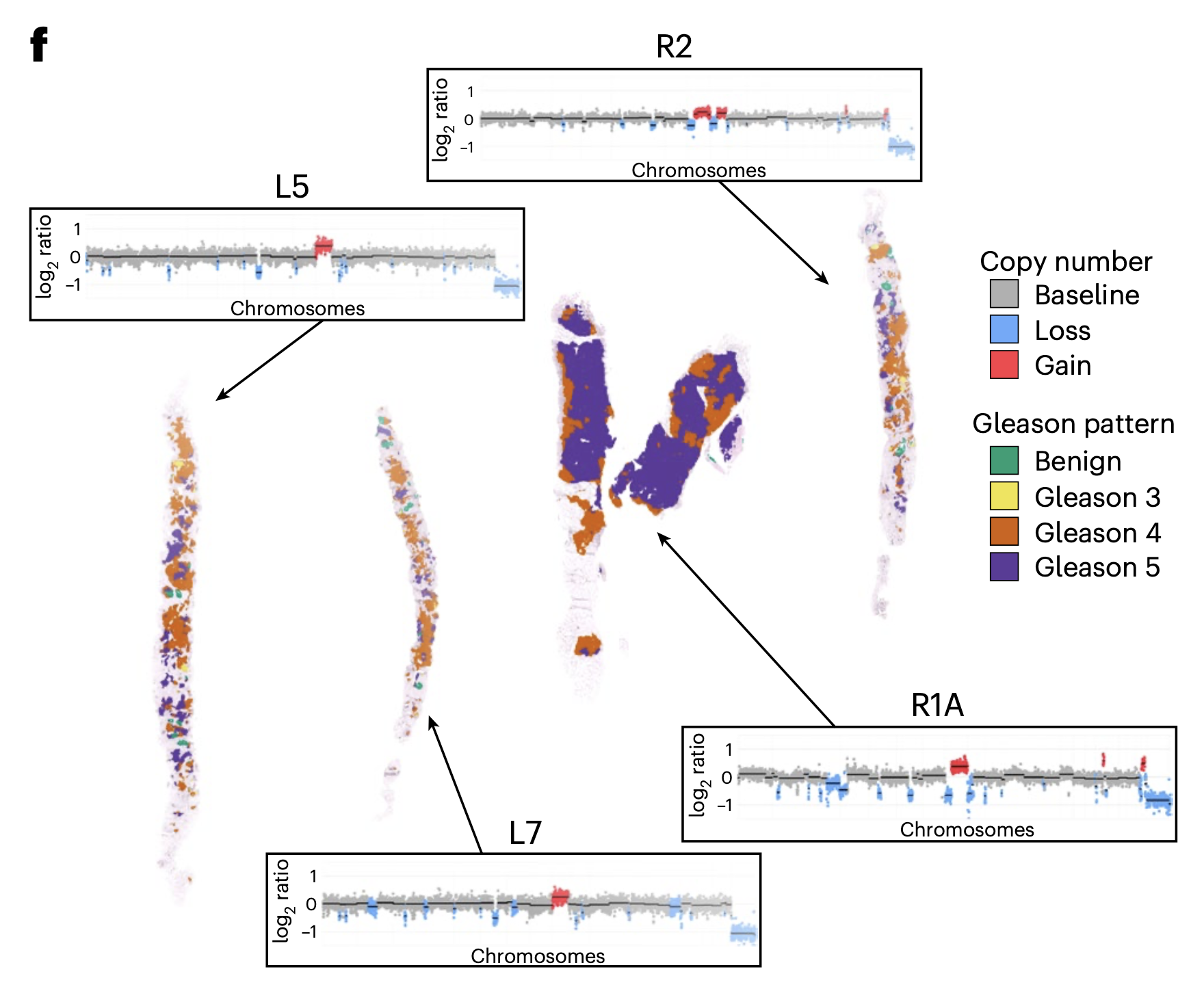 Tumor evolution metrics predict recurrence beyond 10 years in locally advanced prostate cancer